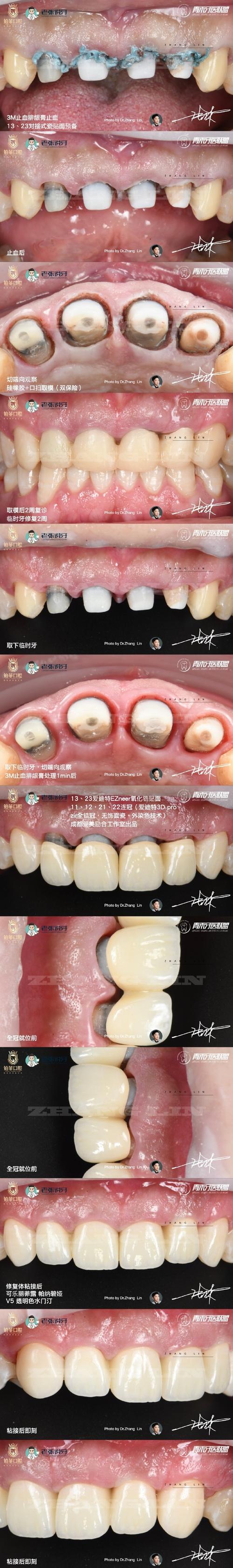 口腔囊肿术后恢复期要多久?