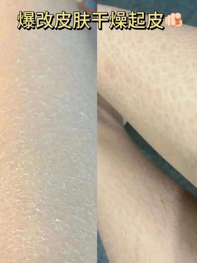 冬天皮肤干燥脱皮怎么办