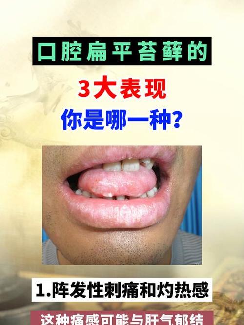 口腔扁平苔藓症状有哪些?
