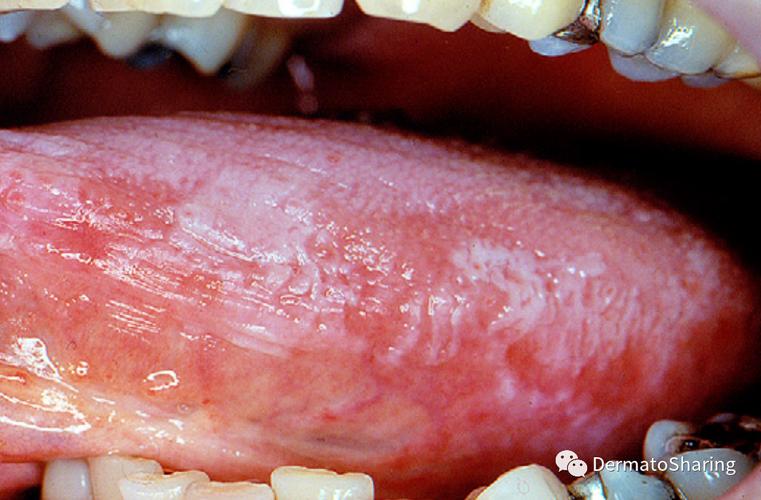 口腔扁平苔藓症状有哪些?
