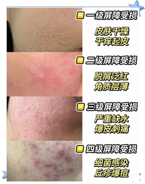 皮肤干燥脱皮,是缺水还是生病了?