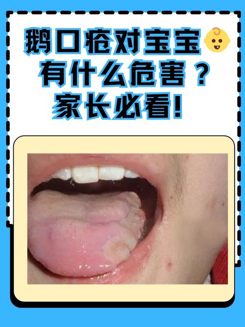 一岁宝宝口腔溃疡,家长该怎么处理?