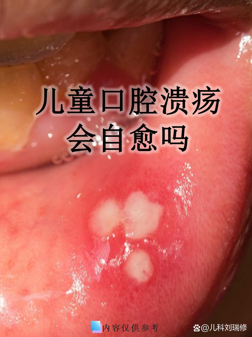 一岁宝宝口腔溃疡,家长该怎么处理?