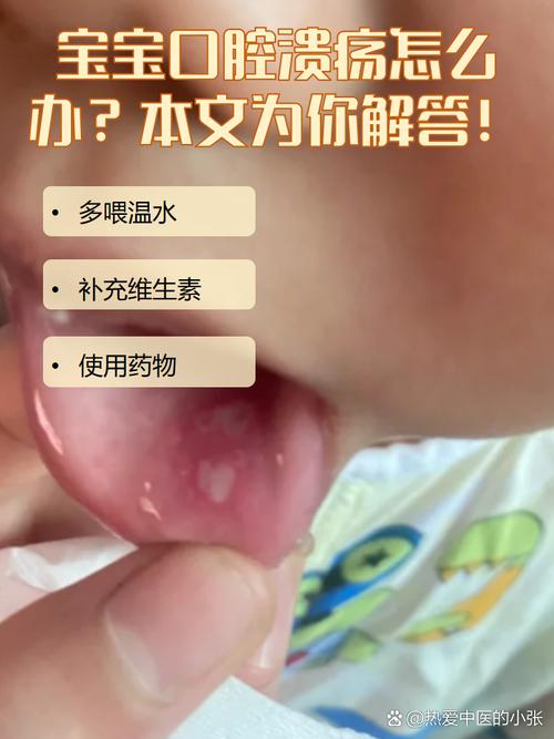 一岁宝宝口腔溃疡,家长该怎么处理?