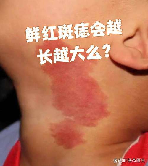 皮肤红斑是何因?如何应对?