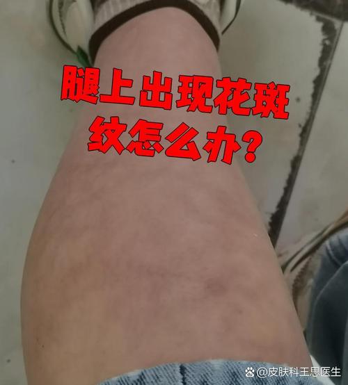 皮肤红斑是何因?如何应对?