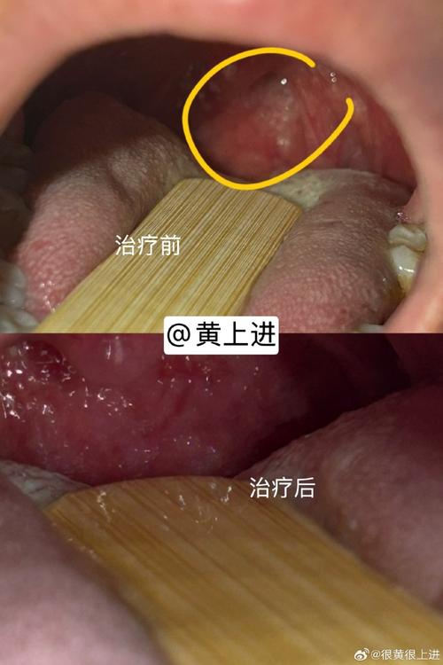 口腔HPV接吻会传染吗?
