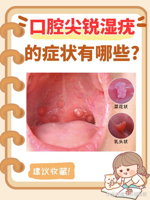 口腔HPV接吻会传染吗?