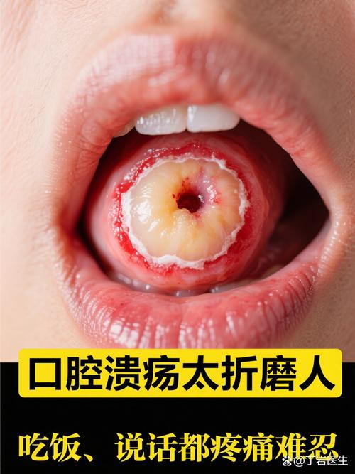 口腔溃疡吃维生素C有用吗?