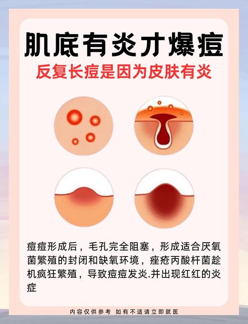 皮肤基底层炎症如何有效解决?