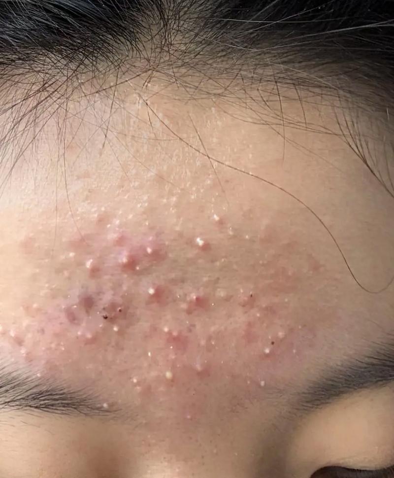 皮肤基底层炎症如何有效解决?