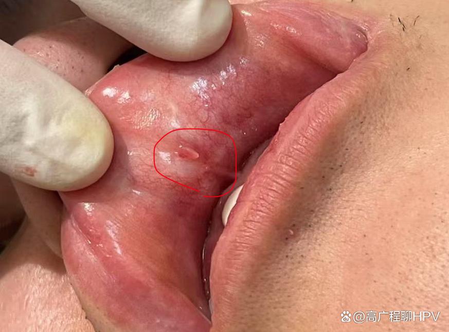 口腔HPV感染早期症状有哪些?