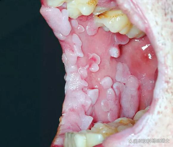 口腔HPV感染早期症状有哪些?