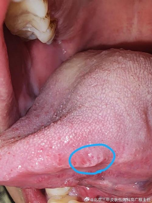 口腔HPV感染早期症状有哪些?