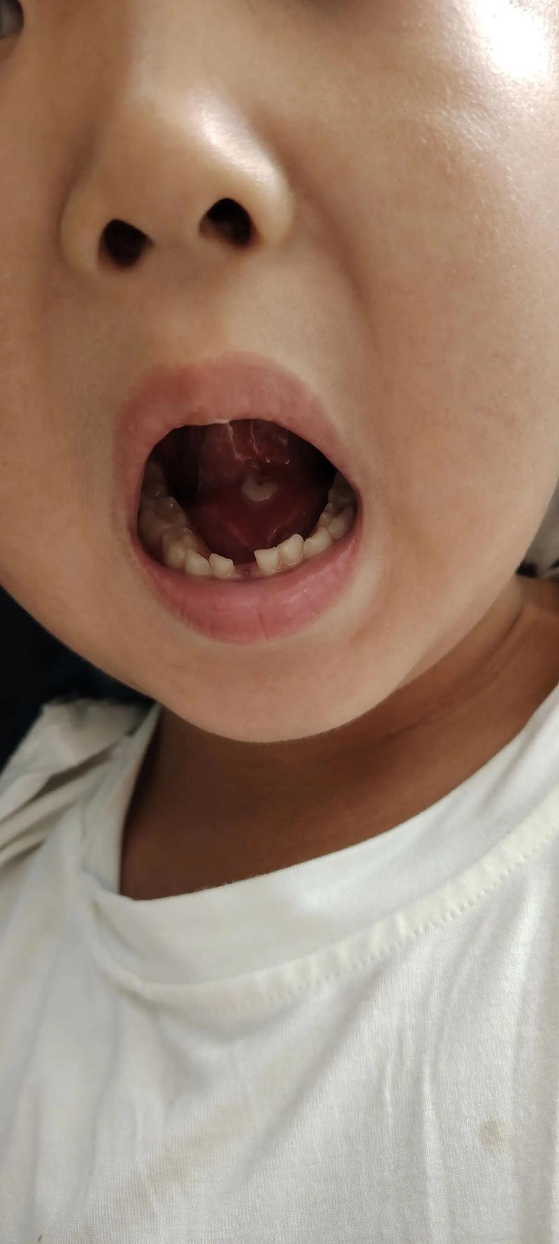 孩子经常口腔溃疡怎么办