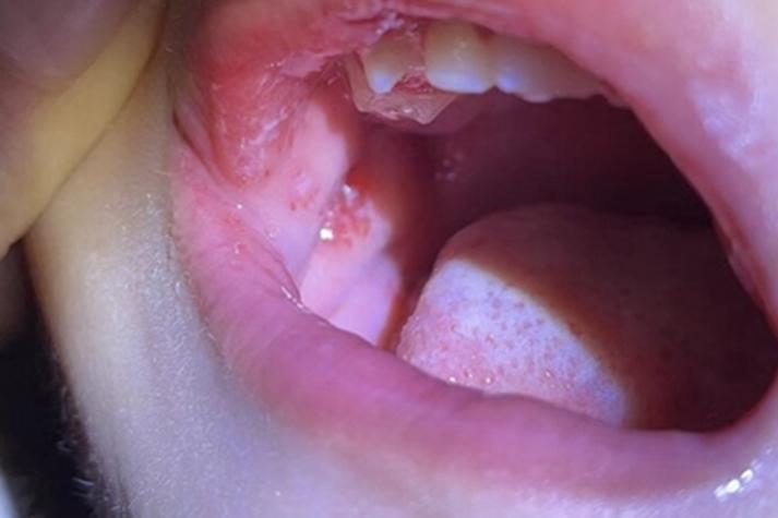 口腔念珠菌感染怎么治疗