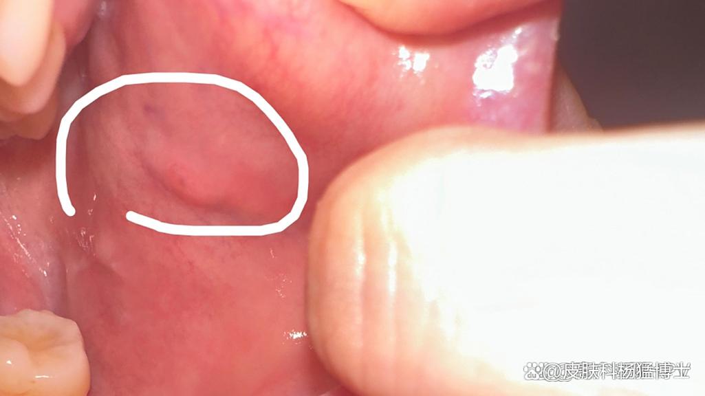 口腔感染HPV能自愈吗?