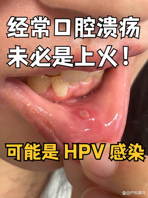 口腔感染HPV能自愈吗?