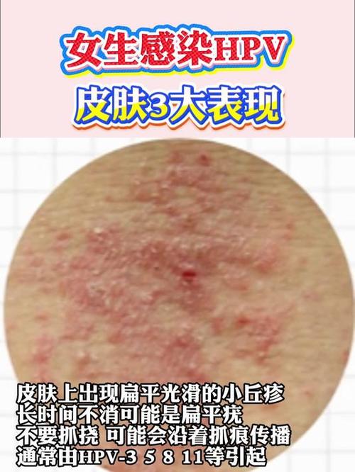 皮肤接触会感染HPV吗?