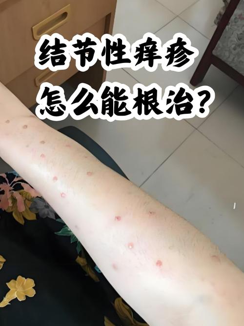 皮肤瘙痒是哪些疾病的前兆?