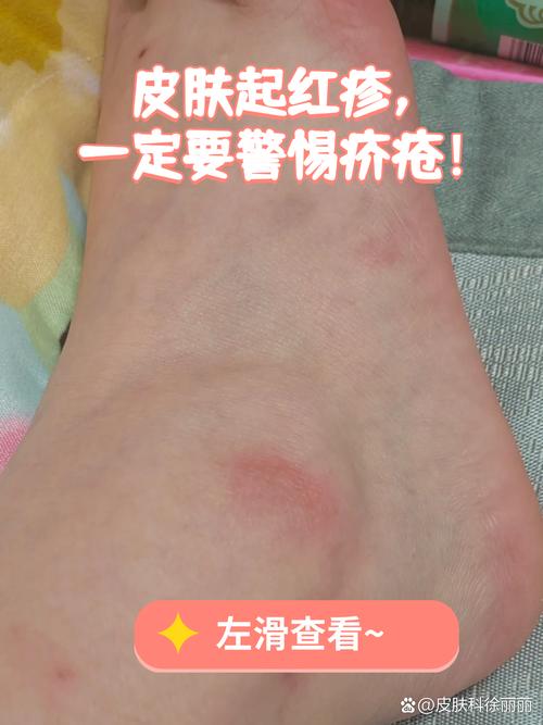 皮肤瘙痒是哪些疾病的前兆?