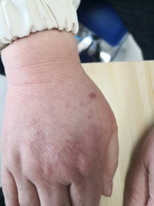 环状肉芽肿是种什么皮肤病?