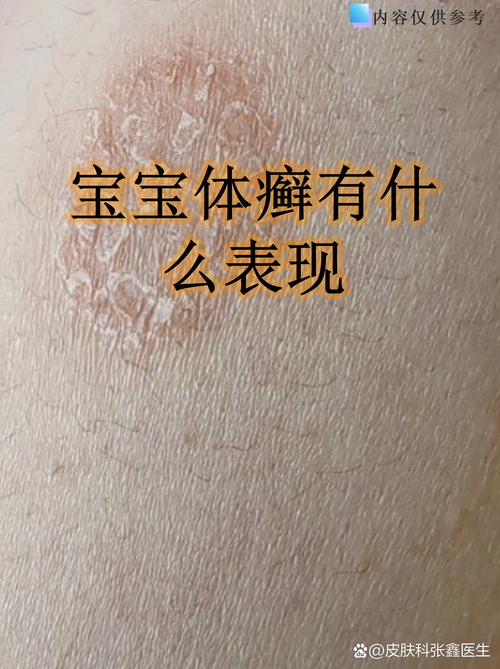 皮肤发红有皮屑是癣吗?如何辨别?