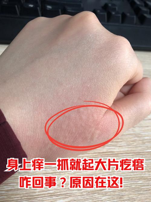 皮肤越抓越痒,为何越抓越严重?