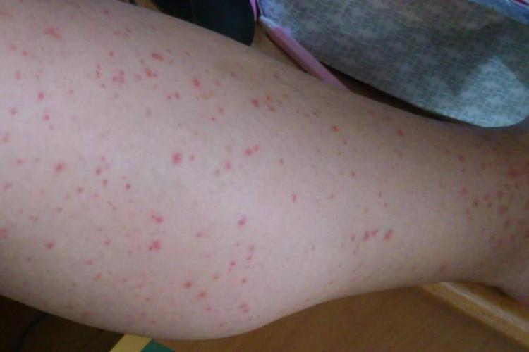 皮肤痒一抓就出血点是啥原因?