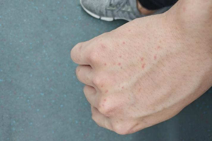 皮肤痒一抓就出血点是啥原因?