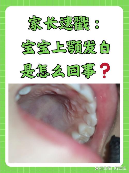 一个月宝宝口腔长白点是鹅口疮吗?