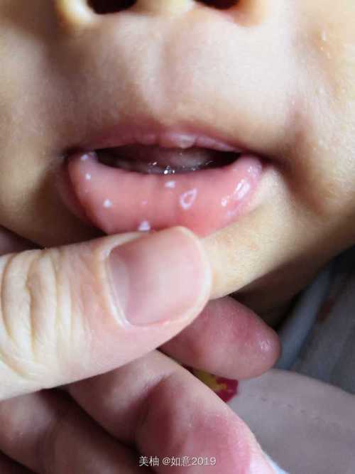 一个月宝宝口腔长白点是鹅口疮吗?