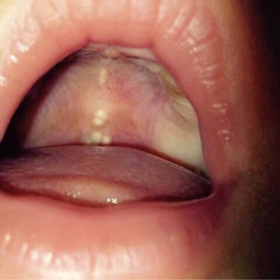 四个月宝宝口腔白点是鹅口疮吗?