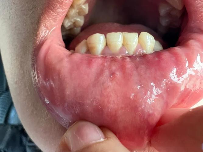 漱口水刺痛口腔是过敏还是用错了?