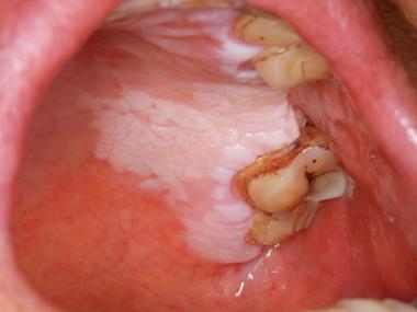 口腔腮帮子有条白棱是何问题?