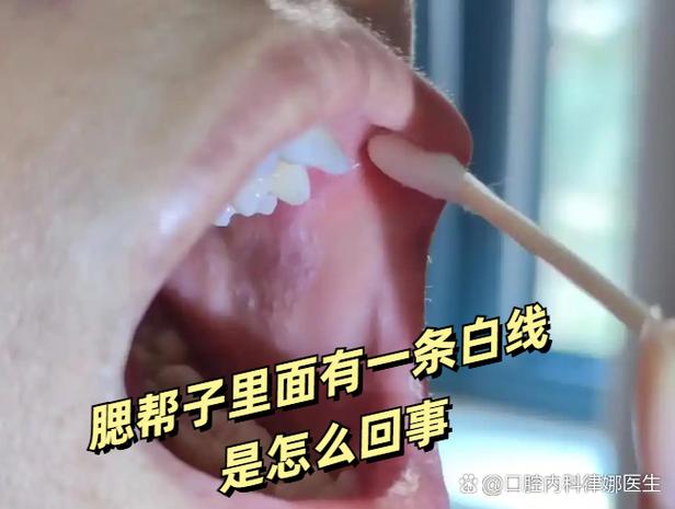 口腔腮帮子有条白棱是何问题?