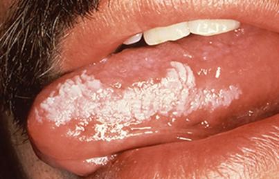 口腔腮帮子有条白棱是何问题?
