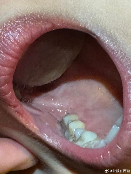 口腔被烫掉皮很疼怎么办?