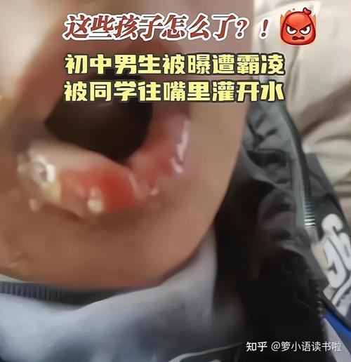 口腔被烫掉皮很疼怎么办?