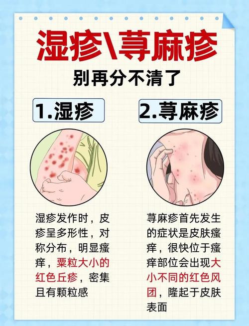 皮肤过敏和荨麻疹是一回事吗?