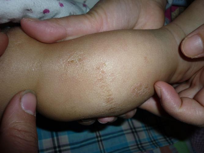 宝宝皮肤上有像癣一样