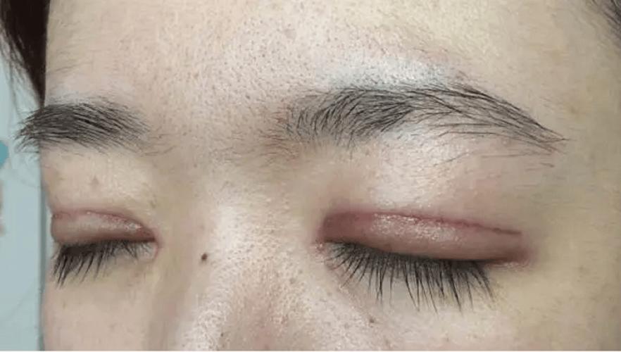 疤痕皮肤割双眼皮会留疤吗?