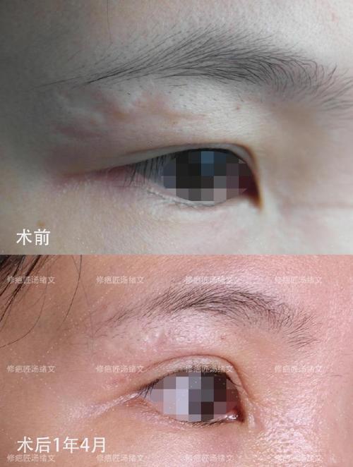 疤痕皮肤割双眼皮会留疤吗?