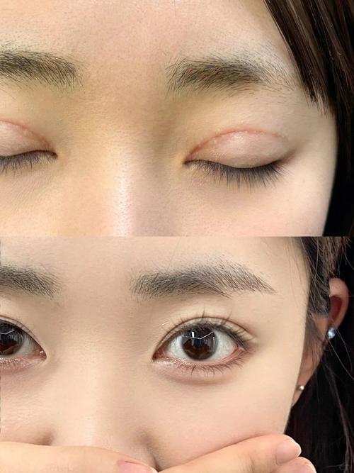 疤痕皮肤割双眼皮会留疤吗?