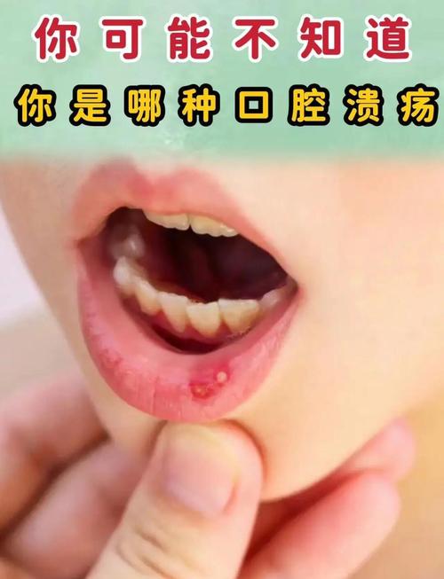 口腔溃疡是缺维生素B几?