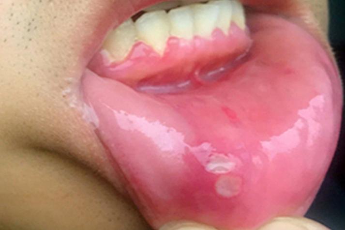 口腔溃疡白色一大块是严重吗?