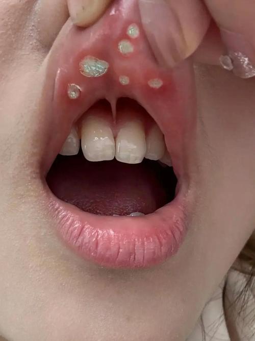 口腔溃疡白色一大块是严重吗?