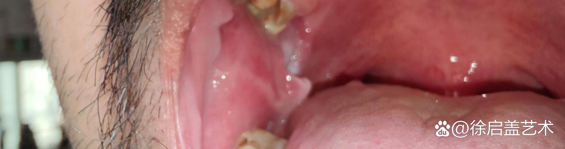 口腔最后面的牙是智齿还是其他问题?