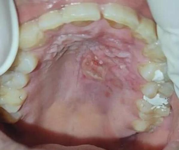 口腔溃疡为何会变成洞?