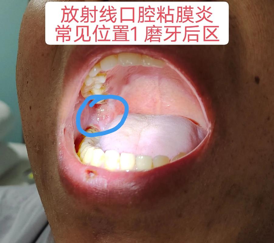 口腔溃疡为何会变成洞?